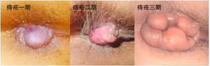 痔疮图片