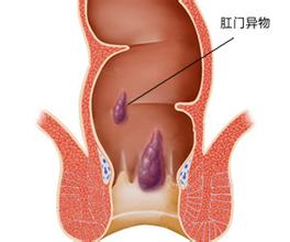 肛门长疙瘩